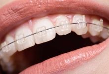 5 Amazing Tips for Oyster Bay Braces: Your Path to a Confident Smile