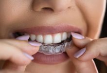 The Ultimate Guide to Oops Aligners: Transforming Your Smile with Confidence