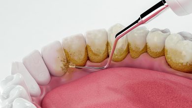 polishing and scaling teeth