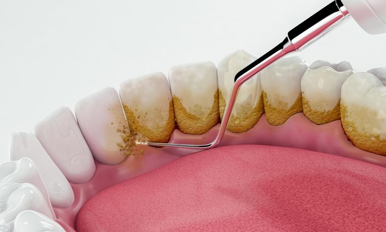 polishing and scaling teeth