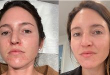 VI Peel Before And After See Visible Skin Changes