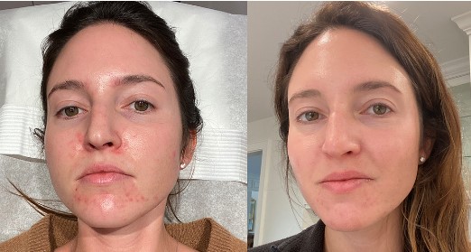 VI Peel Before And After See Visible Skin Changes